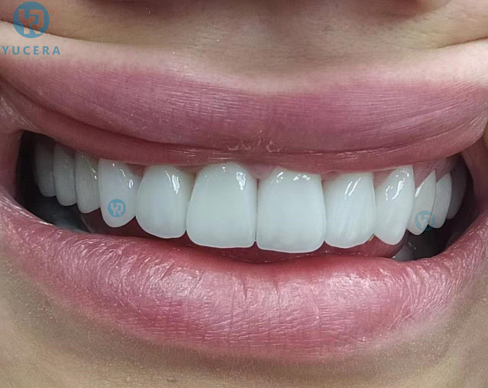 المواد الاستهلاكية لطب الأسنان أقراص الزركونيا للأسنان 98 مم Yucera ST لون أقراص الزركونيا CAD/CAM