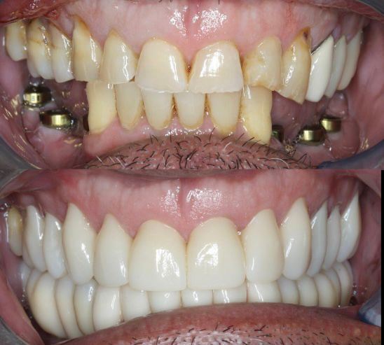 كتلة سيراميك الزركونيا المحددة من Yucera 4D Pro Dental - بتقنية HT Plus لتحسين جودة الترميمات